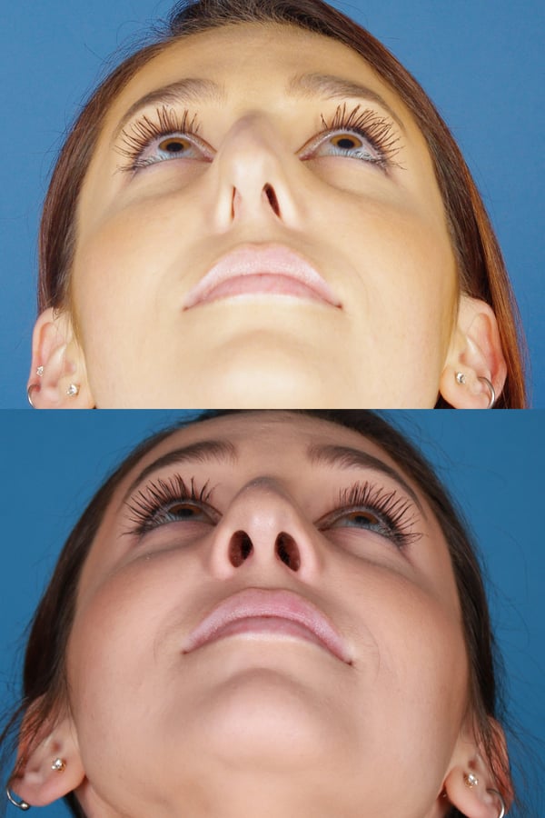 Denver Nasal Airway Surgery Raval Facial Aesthetics